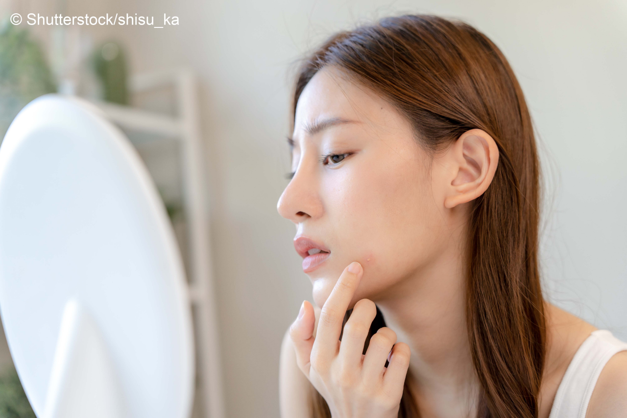 Asian teenage women are worried about acne on faces,Look in the mirror and squeeze the pimple out. hormone acne, inflammatory acne